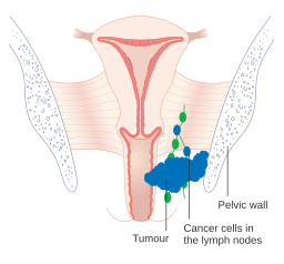 Diagram showing stage 3 vaginal cancer CRUK 223