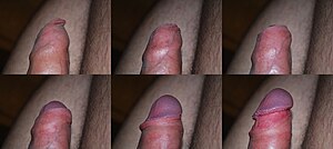 Foreskin retraction image series.jpg