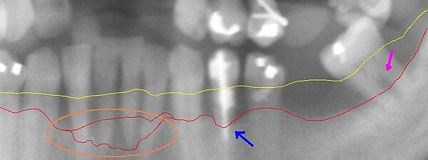 Loss of bone due to periodontal disease