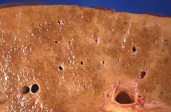 Micronodular cirrhosis, with diffuse areas of pallor.