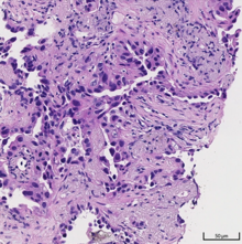 Acinar pattern. Histopathology of lung adenocarcinoma with acinar pattern.png