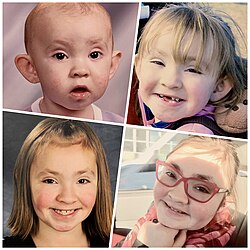 Individual with Kabuki Syndrome from infancy to adulthood