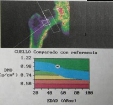 Densitometría ósea