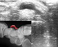 Ultraljud och radiografiska (infällda) bilder av karpalhygroma