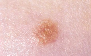 Spitz nevus Human disease