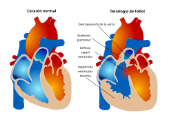 Tetralogie Fallot.es.svg