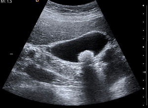 Ultrasound image of gallbladder stone Gallstone 091937515.jpg