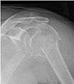 X-ray of complex fracture of proximal humerus