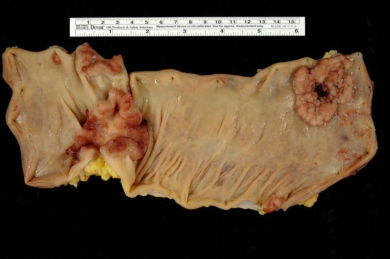 File:Adenocarcinoma (left) and Villous Adenoma (right) in Colon Segment (4768849269).jpg