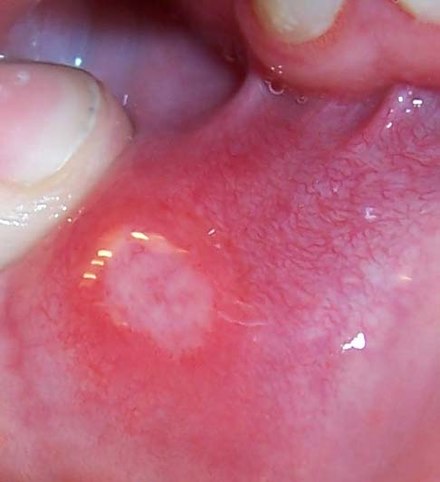 Aphthous ulcers involving the tongue, lips, palate, and pharynx.