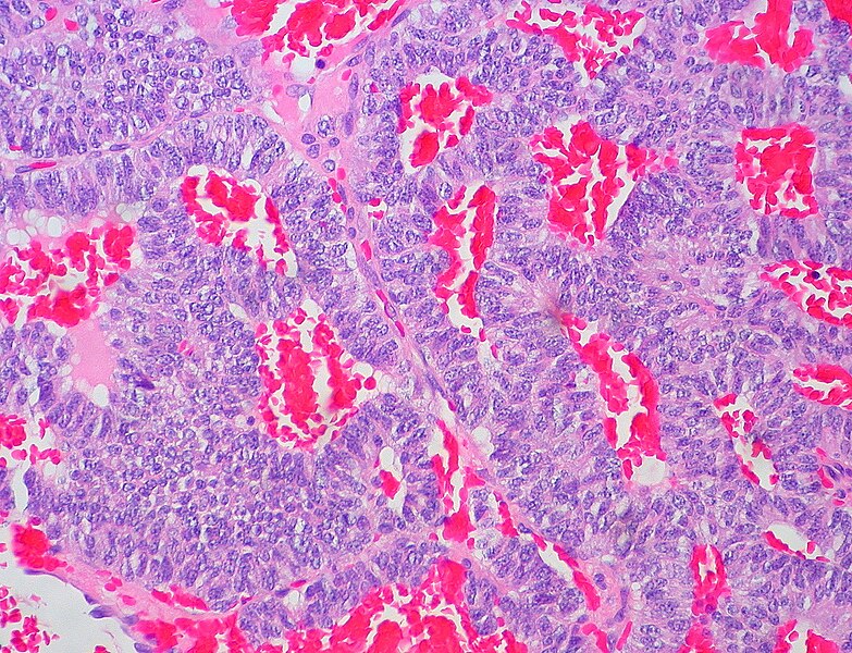 File:Atypical carcinoid tumor.jpg