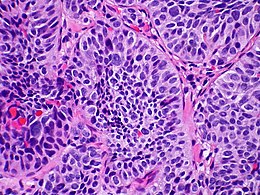 Descripción de la imagen Tumor carcinoide atípico de pulmón metastásico a la glándula suprarrenal Caso 255 (8268009504) .jpg.