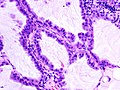 Brochiolo-alveolar carcinoma with mucin production (2).jpg