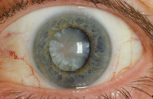 Cataract Cataract (28464844371).png