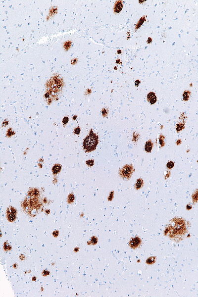 File:Cerebral amyloid angiopathy -2a- amyloid beta - intermed mag.jpg