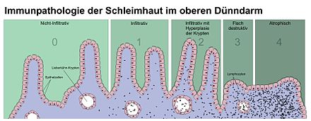 Zöliakie: Namensherkunft, Allergene, Epidemiologie