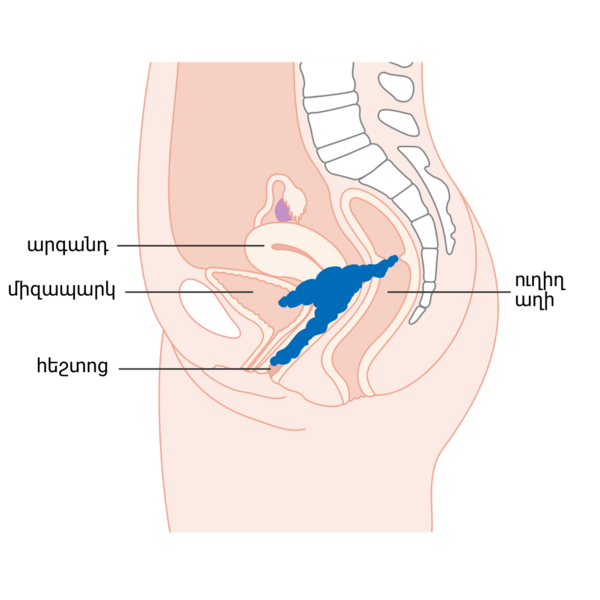 File:Diagram showing stage 4A cervical cancer CRUK 236 (hy).png