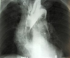 Dissecting aneurysm 01.jpg