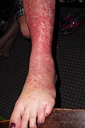 Erythema Multiforme target lesions on the leg