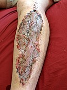 Wound covered with a skin graft once pressure is relieved. Fasciotomy (Post Skin-Graft).jpg