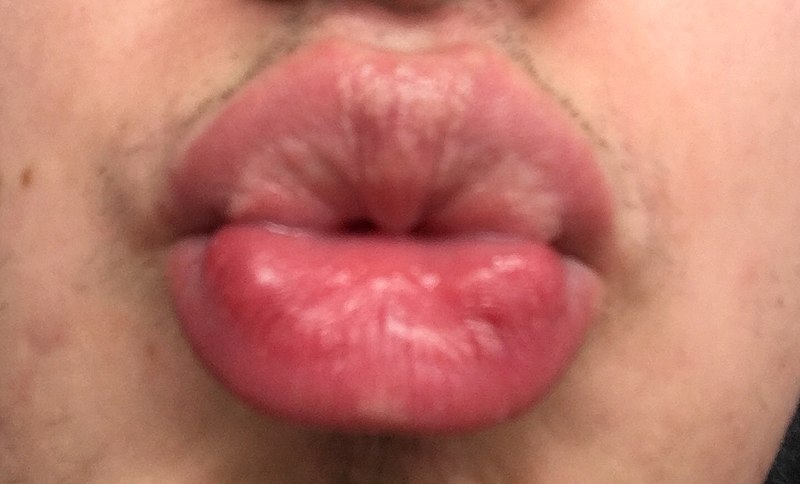 File:Fordyce Spots on Lips.jpg