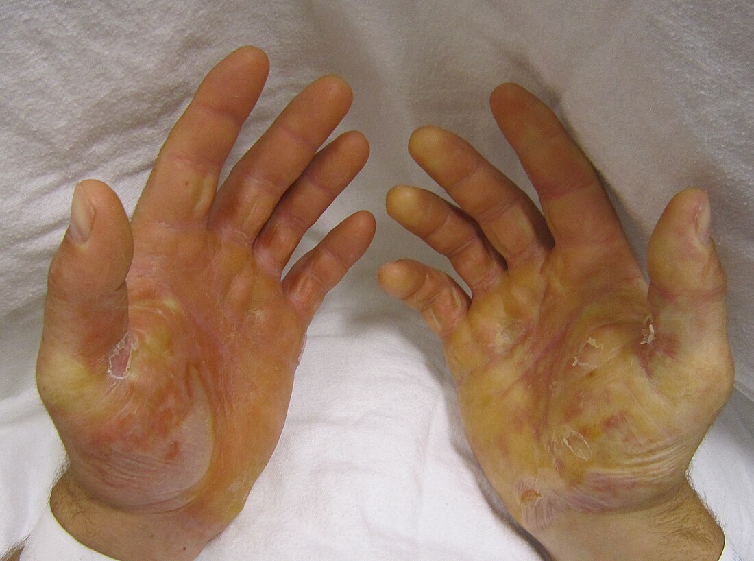 Epidermolysis bullosa simplex