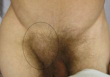 Frontal view of an inguinal hernia (right). Hernia.JPG