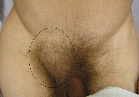 Tập_tin:Hernia.JPG