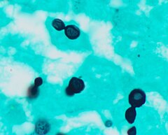 Histopathology of Histoplasma capsulatum, GMS stain, showing narrow budding yeast
