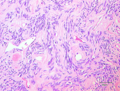 Thumbnail for File:Histopathology of solitary fibrous tumor.png