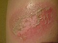 Evolution of infection of a 2nd degree burn; One hour