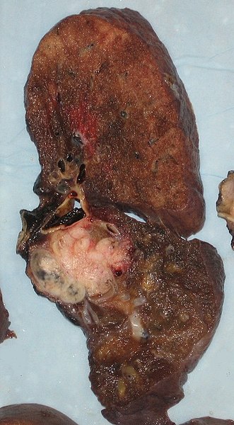 File:Lung cancer.jpg