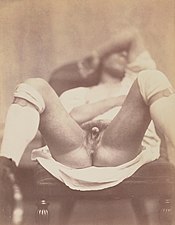 Hermaphrodite (1860), the first medical photodocumentation of an intersex person.
