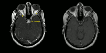Left image: MRI findings (T1-weighted images) in a patient with neurosacoidosis showing thickening of infundibulum and both optic nerves (white signal marked with yellow arrows; width 6 mm).
Right image: MRI brain with contrast showing near resolution of enhancement after treatment. Neurosarcoidosis MRI pre-post treatment arrows.gif