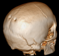 Computertomografi som visar overflata av hovudskallen, med foramen parietale på begge issebeina.