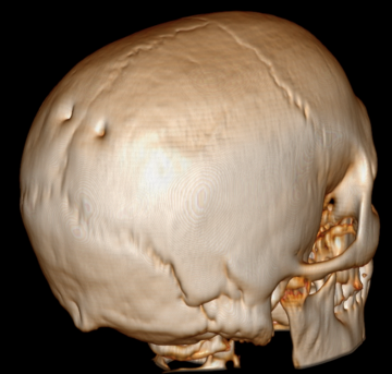 Foramen parietale