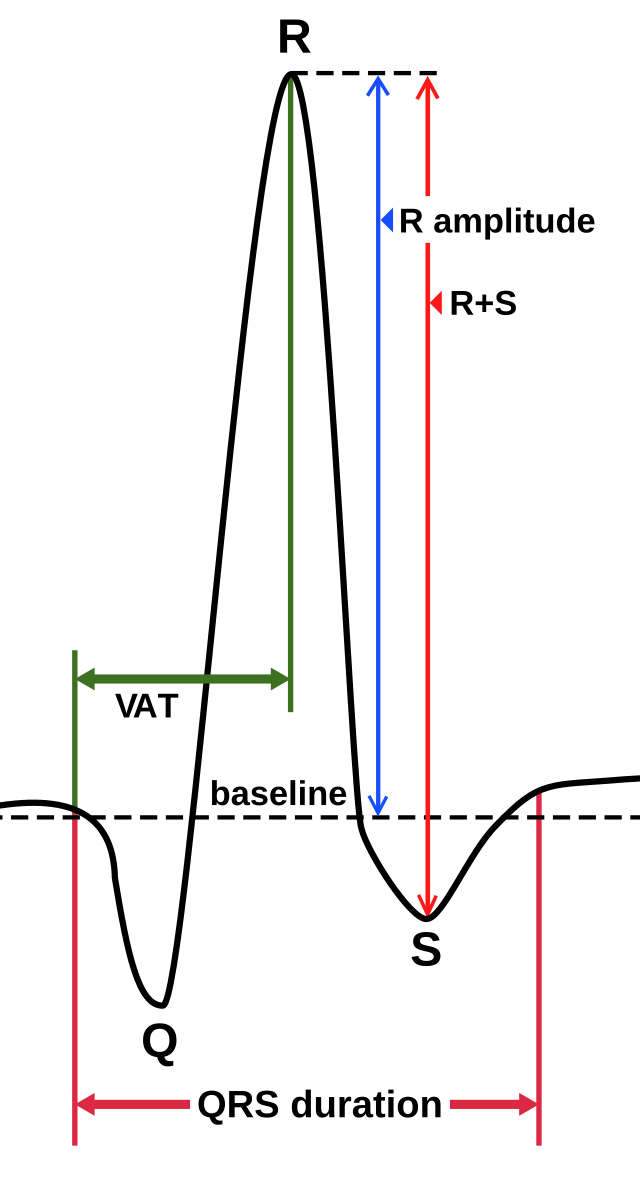 Комплекс QRS. Амплитуда QRS В норме. Низкая амплитуда QRS.