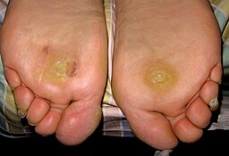 Recurrent plantar warts