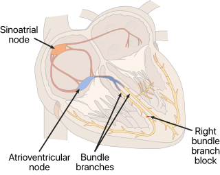 <span class="mw-page-title-main">Right bundle branch block</span> Heart block in the right ventricle