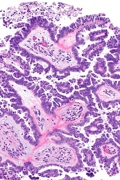 File:Serous borderline tumour with micropapillary pattern - a -- intermed mag.jpg