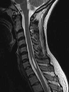 Syringomyelia congenital disorder of nervous system