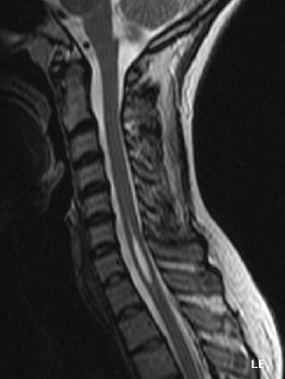 Beskrivelse af syringomyelia.jpg-billedet.