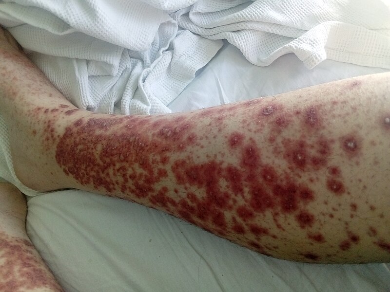 File:Vasculitis 4.jpg