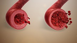 Normal blood vessel (left) vs. vasodilation (right) Vasodilation.jpg