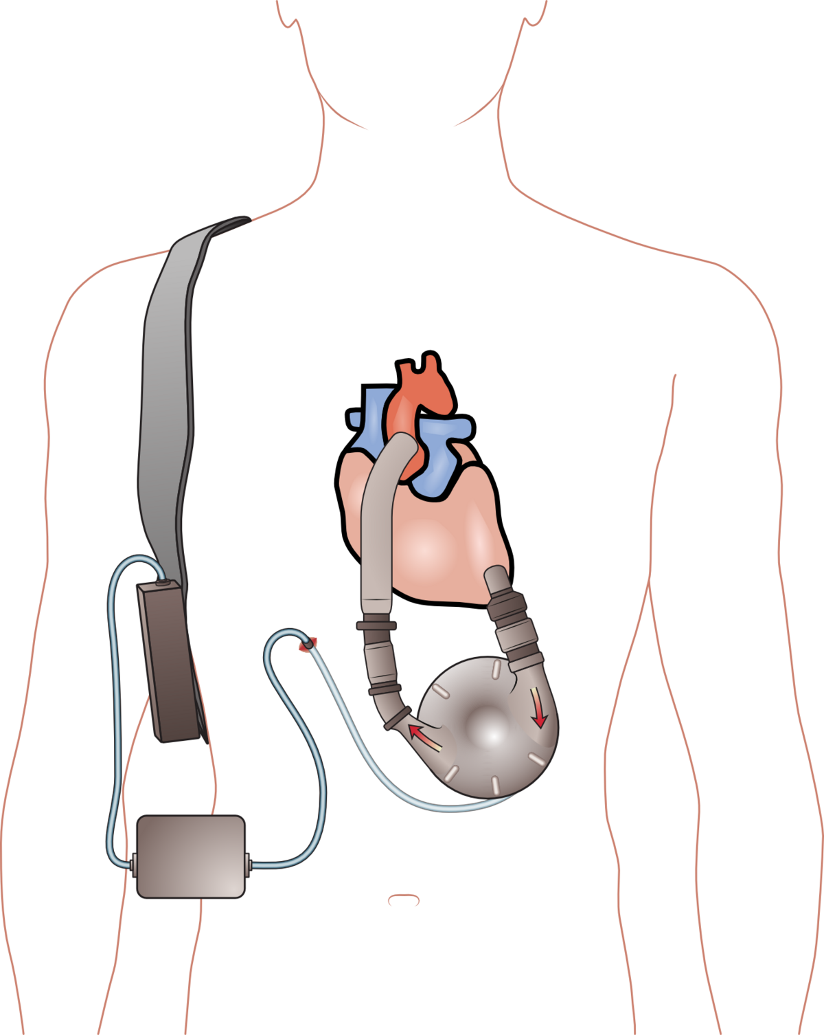 Ventricular assist device - Wikipedia