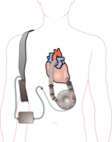 Ventricular assist device