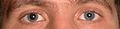 Dilatation de la pupille droite au tropicamide pour un fond d'œil.