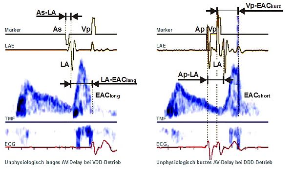 AV-Delay Optimierung