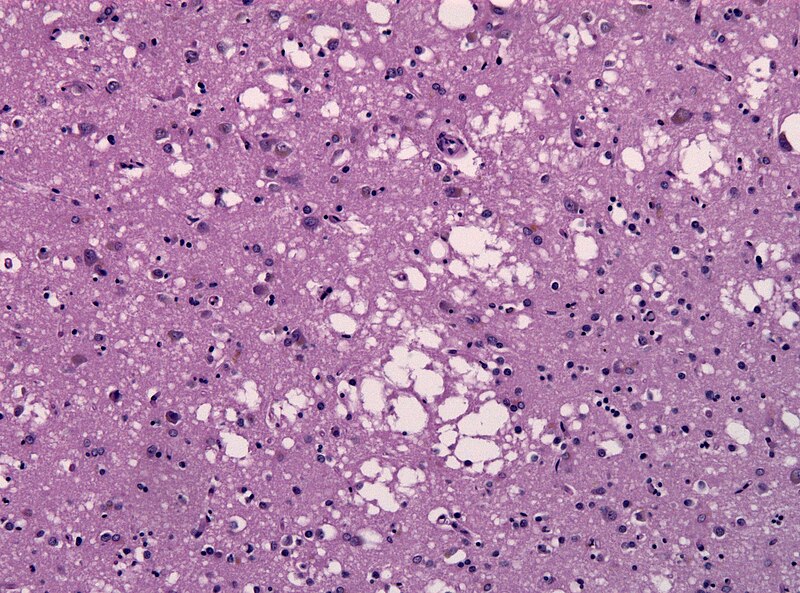 File:CJD spongiosis temporal lobe.jpg