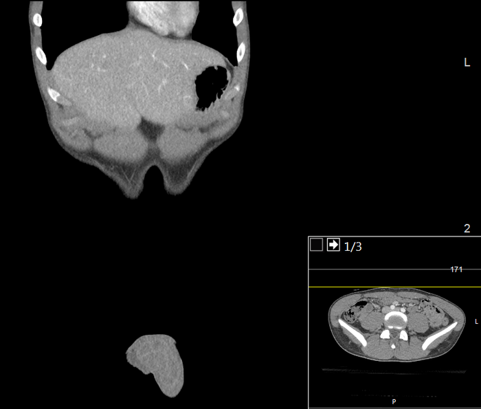 CT of a normal abdomen and pelvis, coronal plane 26.png